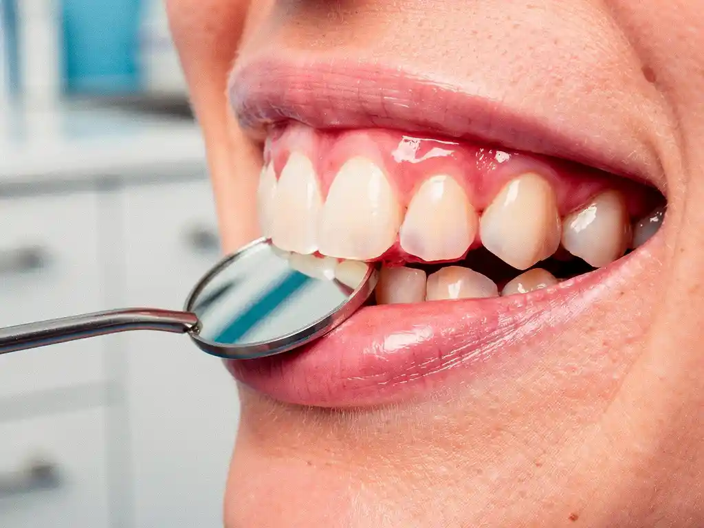 Dental mirror reflecting pink gums showing early inflammation and slight redness along tooth margins during professional examination